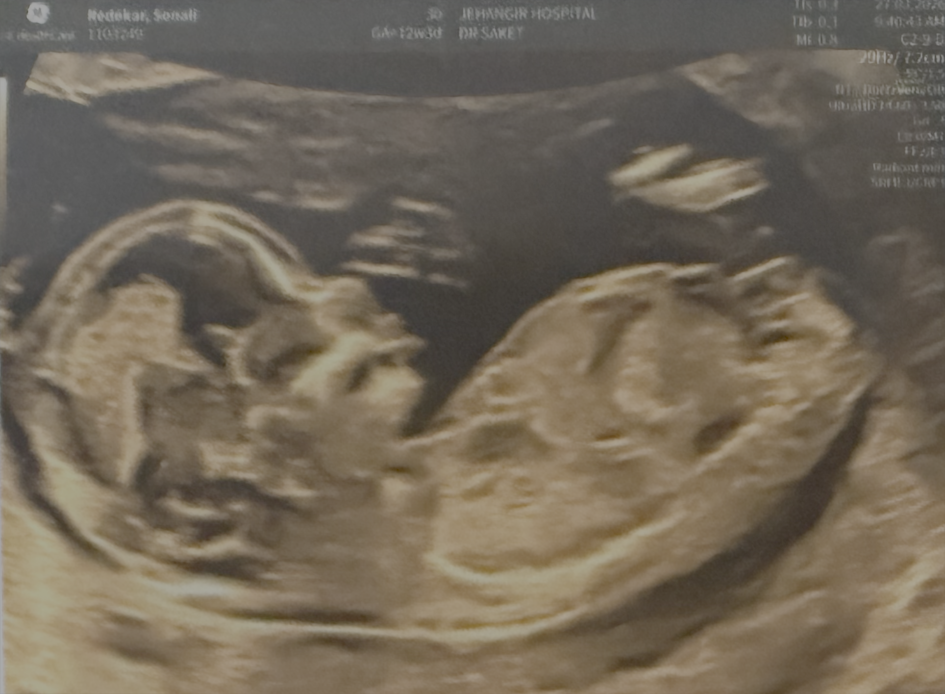 Baby Ultrasound Photo